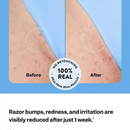 Ingrown Hair Roller (FREE Today)